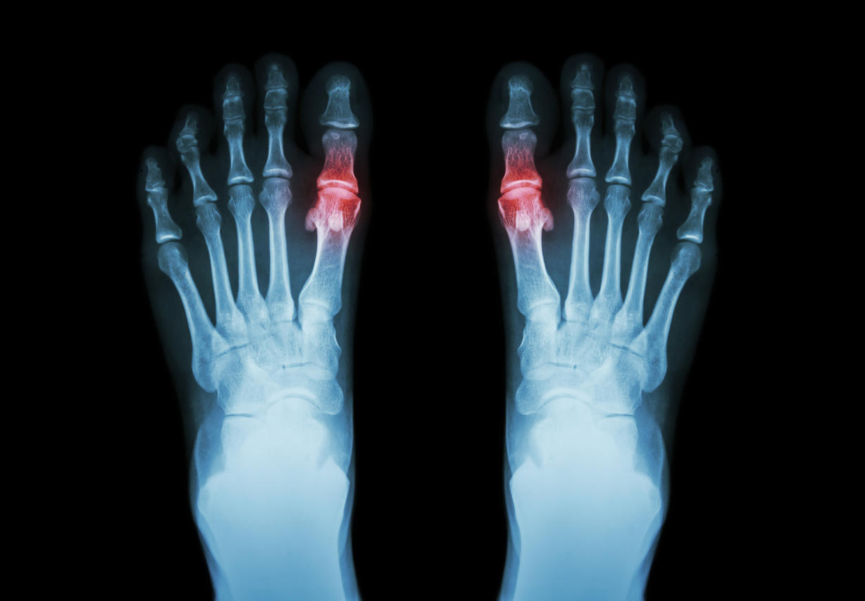 Douleurs arthrosiques: comment les reconnaître?